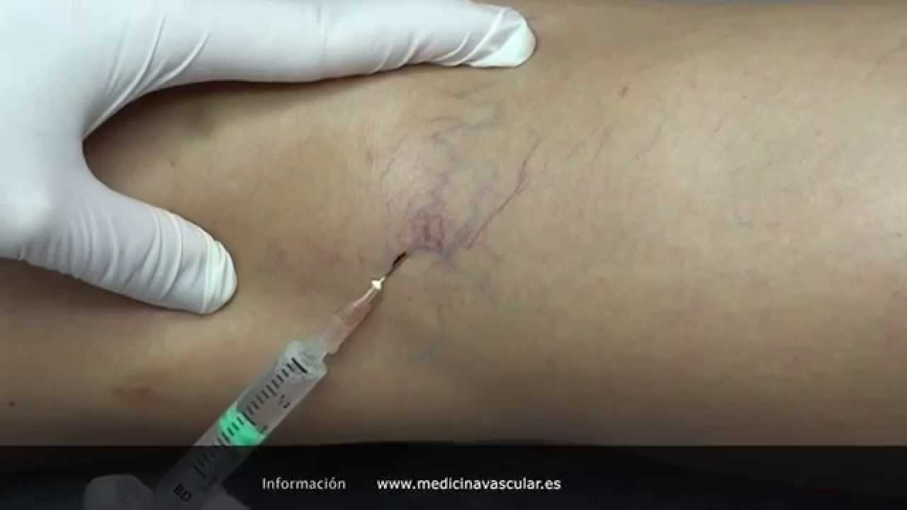 Esclerosis de arañas vasculares