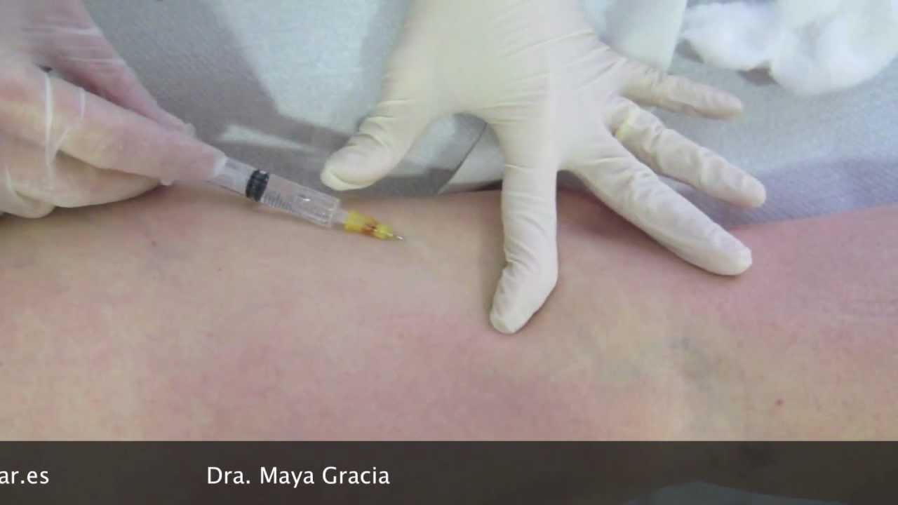 Varices sin cirugía: esclerosis de varices
